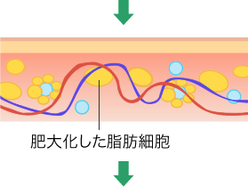 脂肪からセルライトへ