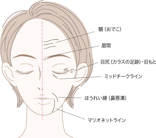 部位別のシワ