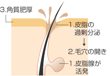脂っぽい肌状態