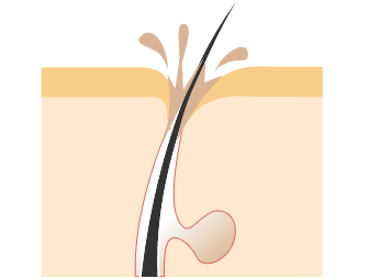 ニキビ生成過程