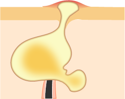 化膿したニキビ
